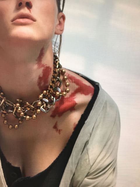 moving birthmarks — Interview Germany